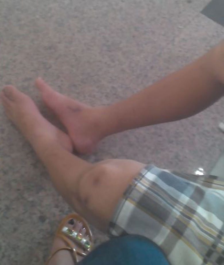 Đ&ocirc;i ch&acirc;y anh Tuấn đang bị teo dần