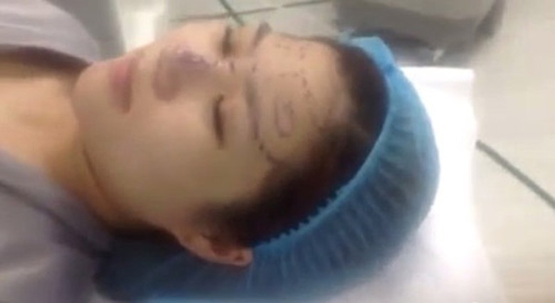 Ảnh cắt từ clip Hương Tr&agrave;m phẫu thuật thẩm mỹ