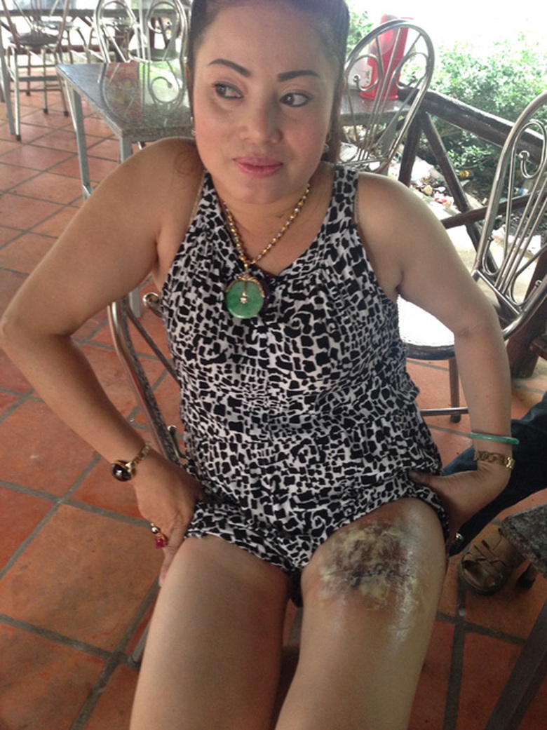 Sau 12 ng&agrave;y nhưng vết thương bỏng của chị vẫn c&ograve;n rất nặng