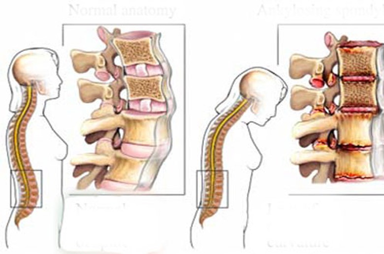 Bệnh tho&aacute;t vị đĩa đệm (Ảnh minh hoạ)