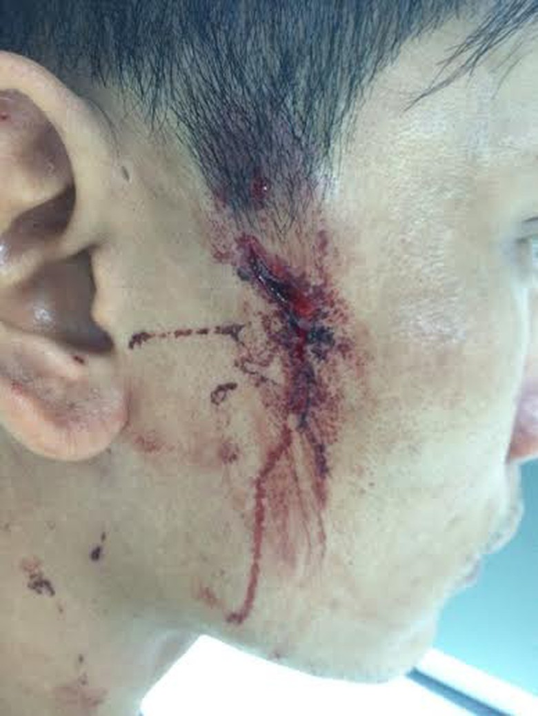 Vế thương bị đ&aacute;nh tr&ecirc;n mặt anh Thịnh