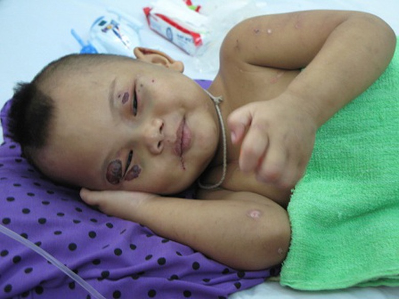 Sức khỏe của b&eacute; Kh&ocirc;i đang dần b&igrave;nh phục. Ch&aacute;u đ&atilde; ăn ch&aacute;o, uống sữa được (Ảnh: D&acirc;n Tr&iacute;)