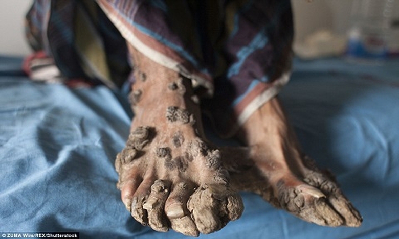 Bàn chân với đốm mụn cóc sần sùi.