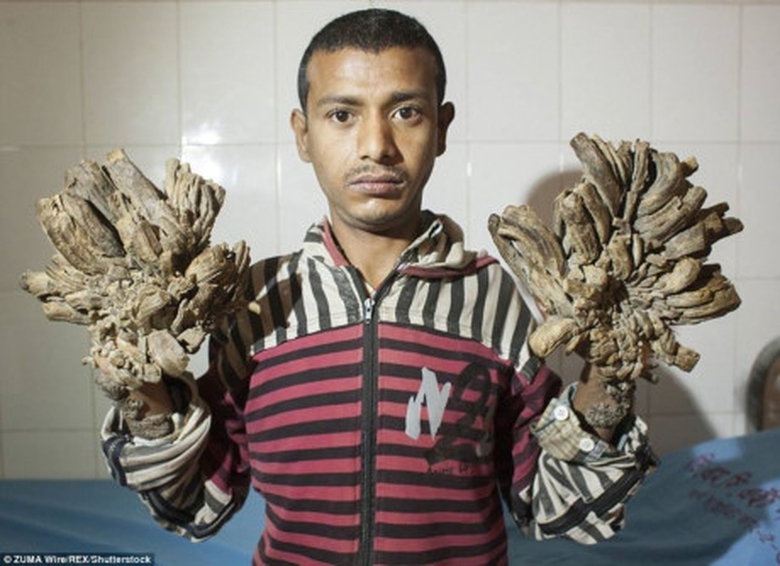 Căn bệnh khiến Abu phải từ bỏ công việ