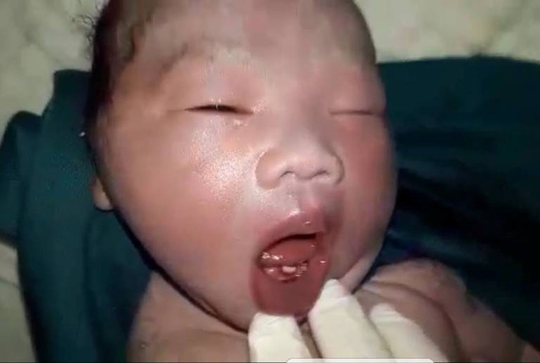 Kỳ lạ ch&aacute;u b&eacute; vừa sinh đ&atilde; mọc răng cửa