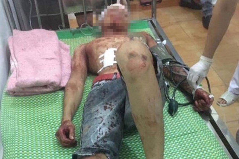 Nạn nh&acirc;n bị ch&eacute;m d&atilde; man bởi nh&oacute;m c&ocirc;n đồ