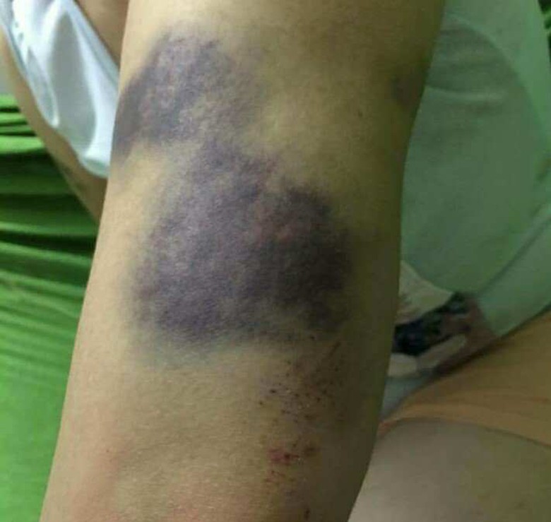 V&ecirc;́t thương của chị M