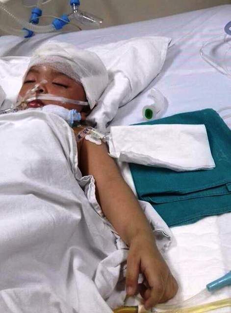 B&eacute; 3 tuổi bị c&aacute;n vợt cầu l&ocirc;ng đ&acirc;m xuy&ecirc;n n&atilde;o