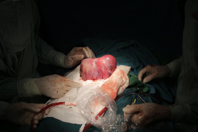 4. H&igrave;nh ảnh tử cung c&oacute; khối u xơ lớn