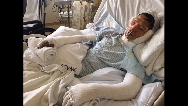 &Ocirc;ng Sơn Nguyễn bị bỏng nặng