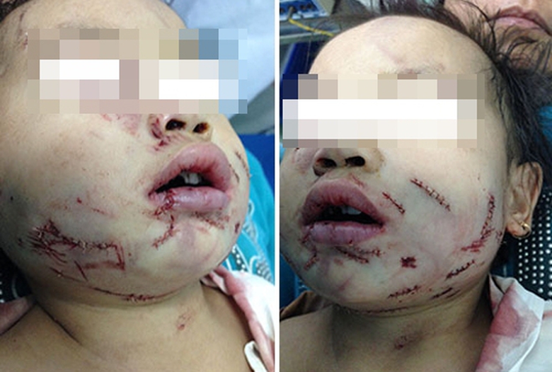 Trẻ bị ch&oacute; cắn