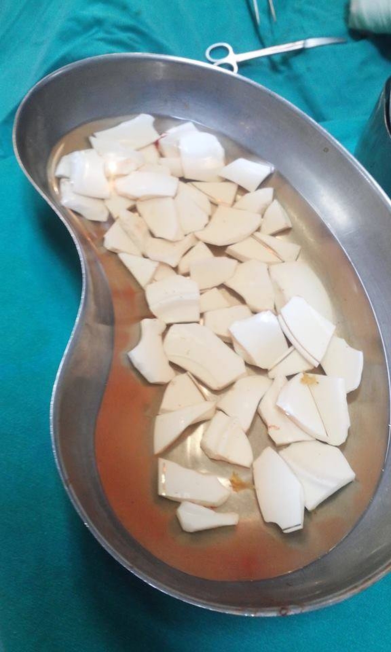 59 manh sanh trong bung benh nhan