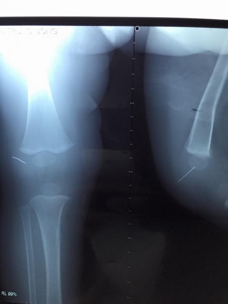 Kim-trong-khop-goi-tre-em