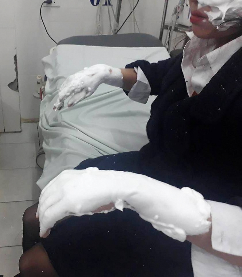 bỏng nổ b&oacute;ng 1