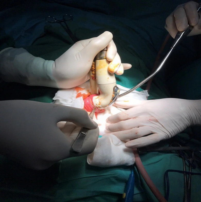 dị vật hậu m&ocirc;n