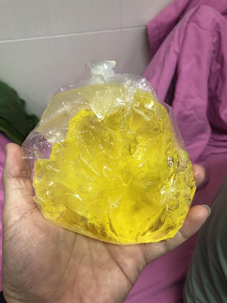 t&uacute;i ngực bị vỡ