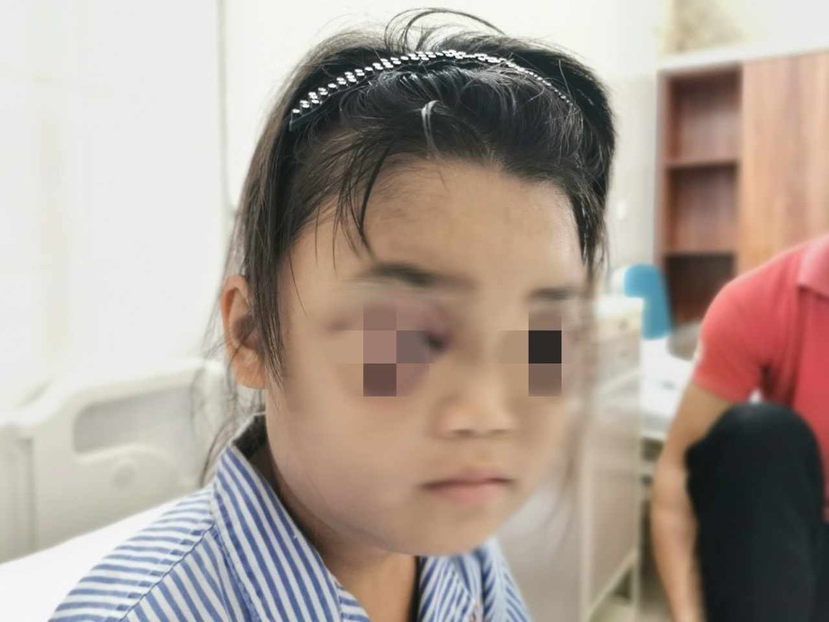 Đ&igrave;nh chỉ gi&aacute;o vi&ecirc;n d&ugrave;ng thước kẻ đ&aacute;nh sưng mắt học sinh- Ảnh 1.
