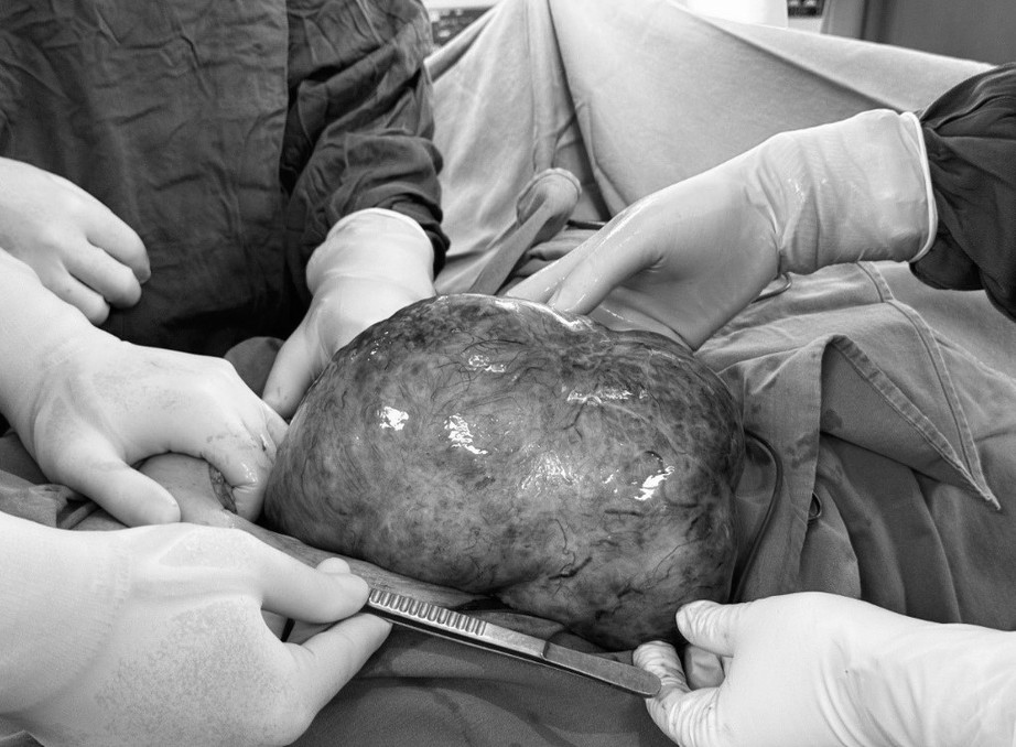 Tự d&ugrave;ng thuốc, 1 phụ nữ nguy kịch với khối ung thư buồng trứng "khủng"- Ảnh 1.