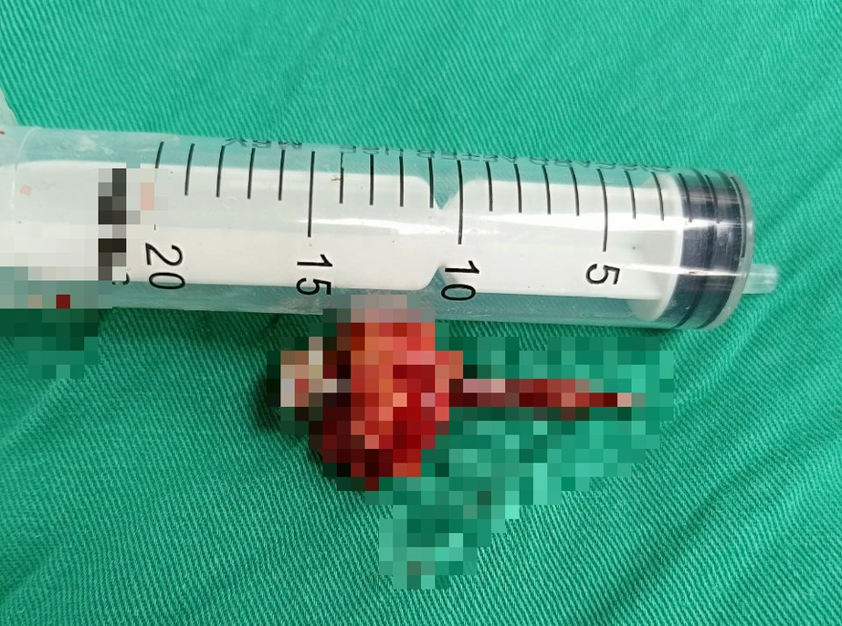 Người đ&agrave;n &ocirc;ng thường xuy&ecirc;n mất ngủ tự đ&oacute;ng c&acirc;y đinh d&agrave;i 5cm v&agrave;o đầu- Ảnh 2.