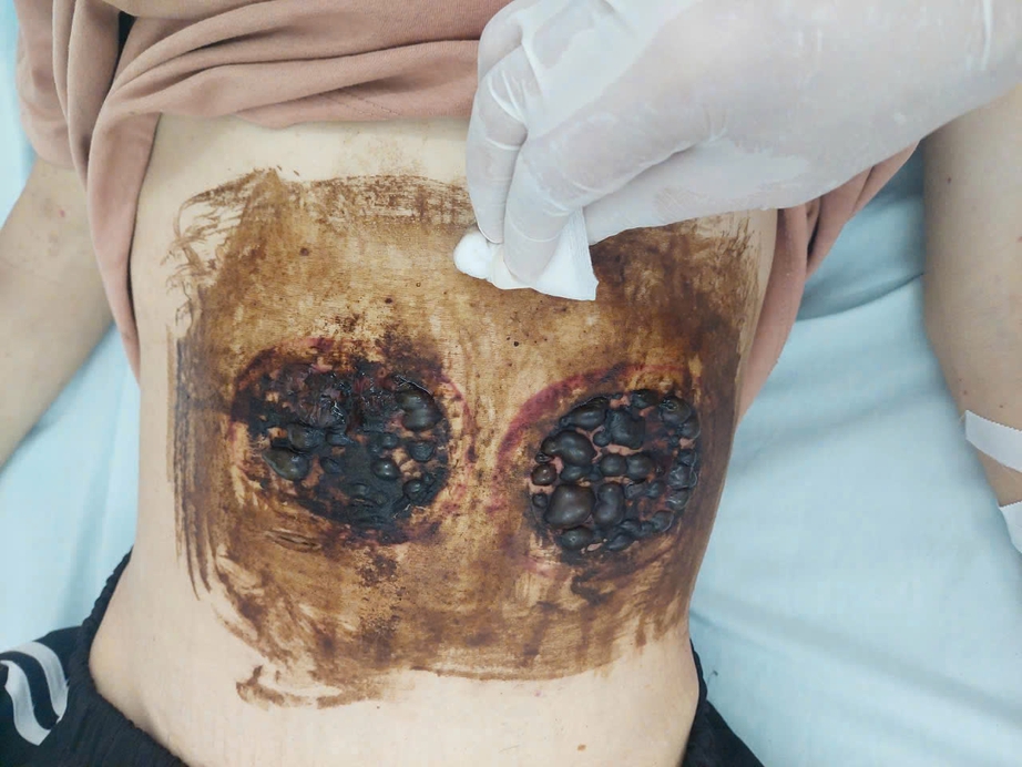 Tự điều trị ung thư máu bằng đắp thuốc "giác hơi", nam thanh niên nguy kịch- Ảnh 1. Tự điều trị ung thư máu bằng đắp thuốc "giác hơi", nam thanh niên nguy kịch- Ảnh 1.