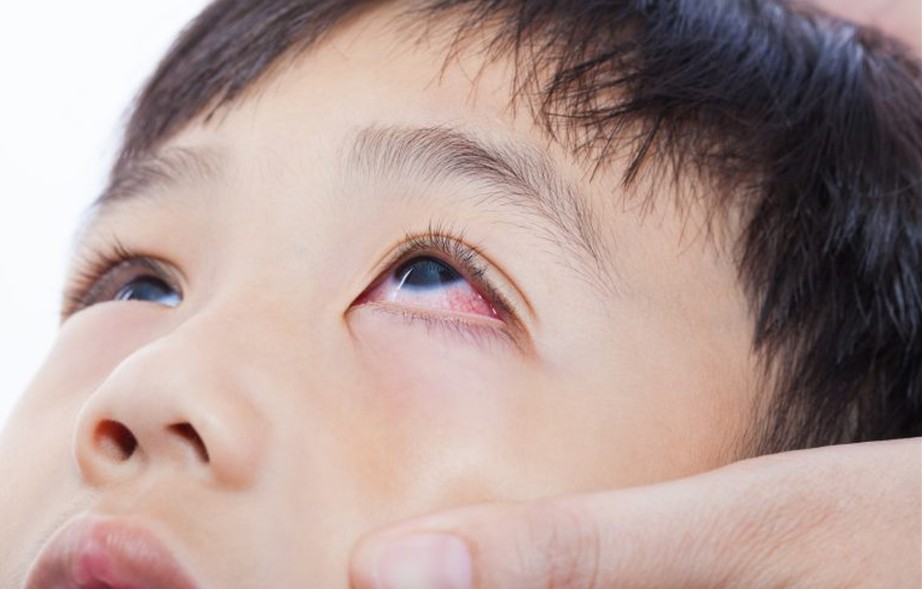 Trẻ nhiễm c&uacute;m, sởi, cha mẹ cần lưu &yacute; th&ecirc;m dấu hiệu n&agrave;y- Ảnh 1.