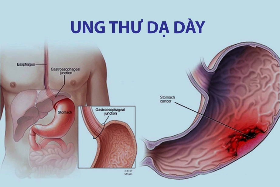 Dấu hiệu n&agrave;o nhận biết ung thư dạ d&agrave;y?- Ảnh 1.