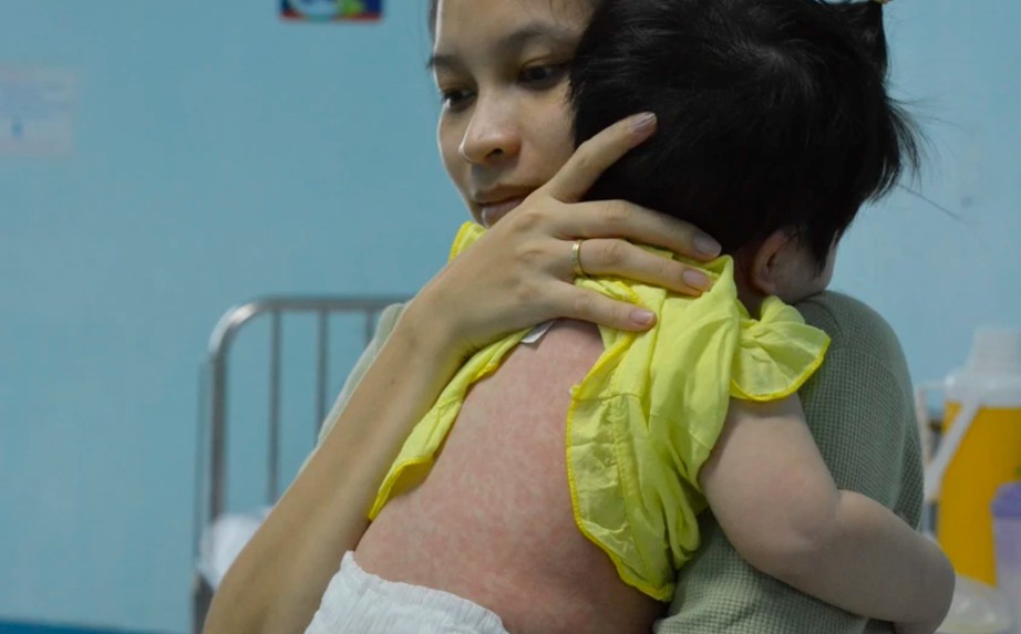 Sởi l&acirc;y nhanh hơn Covid-19, Bộ Y tế khuyến c&aacute;o 5 biện ph&aacute;p ph&ograve;ng bệnh- Ảnh 1.