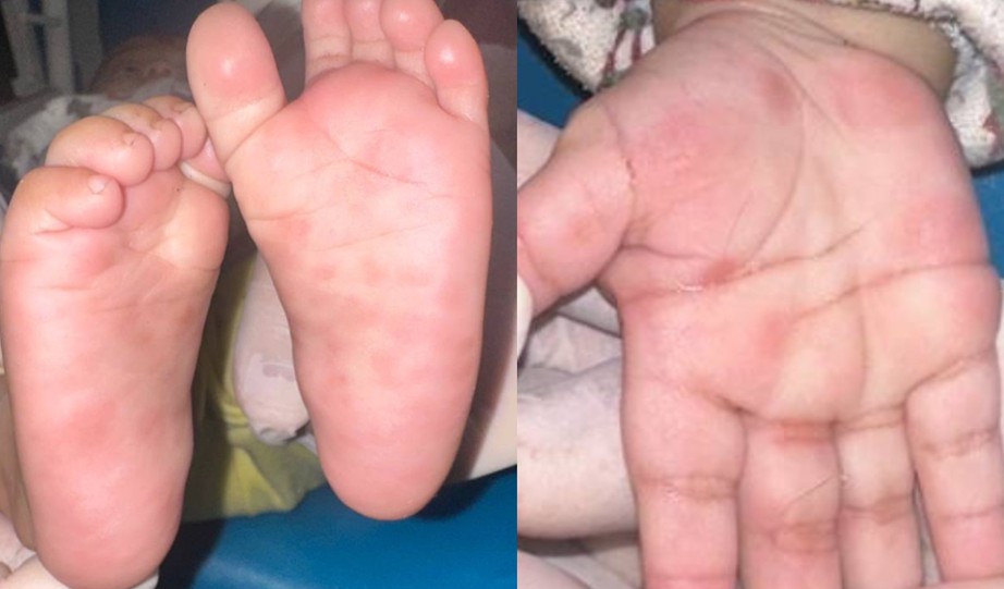 Bất ngờ phát hiện trẻ sơ sinh mắc giang mai từ dấu hiệu này- Ảnh 1. Bất ngờ phát hiện trẻ sơ sinh mắc giang mai từ dấu hiệu này- Ảnh 1.