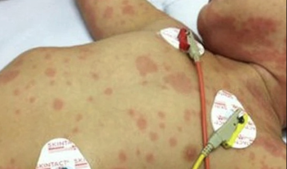 TP.HCM ghi nhận ca tử vong do n&atilde;o m&ocirc; cầu, cảnh b&aacute;o bệnh diễn tiến cực nhanh- Ảnh 1.