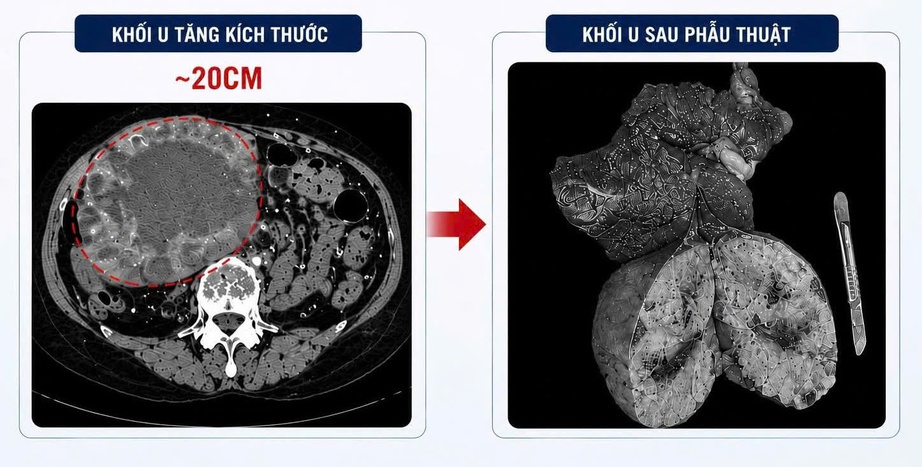 Tự &yacute; uống thuốc nam, một phụ nữ nhập viện với khối u gan "khủng"- Ảnh 2.