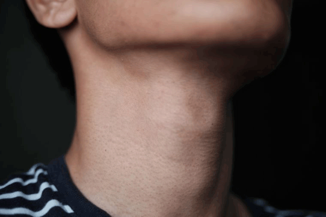 1. Khó nuốt: David Poppers, bác sĩ tiêu hóa tại Trung tâm Sức khỏe Nam giới Tisch ở thành phố New York cho biết, khó nuốt là một triệu chứng mà nam giới không bao giờ nên bỏ qua. Đây là một trong những dấu hiệu của trào ngược axit, dị ứng hoặc có thể là ung thư thực quản. Trào ngược axit mãn tính có thể gây ra những thay đổi tiền ung thư ở thực quản.