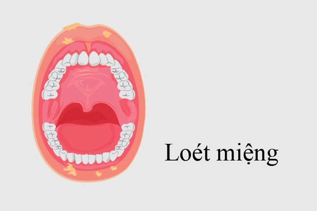 1. Lo&eacute;t miệng: Theo chuy&ecirc;n gia, nếu vết lo&eacute;t miệng k&eacute;o d&agrave;i khoảng 2 tuần trở l&ecirc;n c&oacute; thể l&agrave; dấu hiệu của bệnh ung thư miệng. Dấu hiệu đau nhức cũng c&oacute; thể tiết lộ bạn c&oacute; khả năng bị ung thư hay kh&ocirc;ng. Hầu hết vết lo&eacute;t l&agrave;nh t&iacute;nh đều kh&aacute; mỏng v&agrave; mềm, trong khi c&aacute;c khối u d&agrave;y v&agrave; cứng hơn. Th&ecirc;m v&agrave;o đ&oacute;, vết lo&eacute;t l&agrave;nh t&iacute;nh hiếm khi chảy m&aacute;u, trong khi khối u chảy m&aacute;u thường xuy&ecirc;n.
