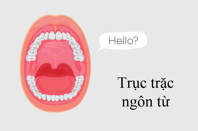 10. Trục trặc ng&ocirc;n từ: Ung thư miệng ảnh hưởng đến lưỡi c&oacute; thể l&agrave;m cho việc n&oacute;i chuyện trở n&ecirc;n đau đớn hoặc c&oacute; thể khiến việc di chuyển lưỡi của bạn trở n&ecirc;n kh&oacute; khăn hơn. Khi một trong những điều đ&oacute; xảy ra, bạn c&oacute; thể nhận thấy m&igrave;nh gặp kh&oacute; khăn khi ph&aacute;t &acirc;m những từ m&agrave; bạn chưa bao giờ gặp rắc rối trước đ&oacute;.
