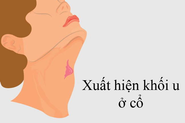 12. Xuất hiện khối u ở cổ: Khi ung thư miệng l&acirc;y lan, c&aacute;c hạch bạch huyết thường l&agrave; nơi tiếp theo bị ảnh hưởng, mặc d&ugrave; bạn c&oacute; thể sẽ nhận thấy c&aacute;c triệu chứng trong miệng trước khi thấy 1 khối u ở cổ.
