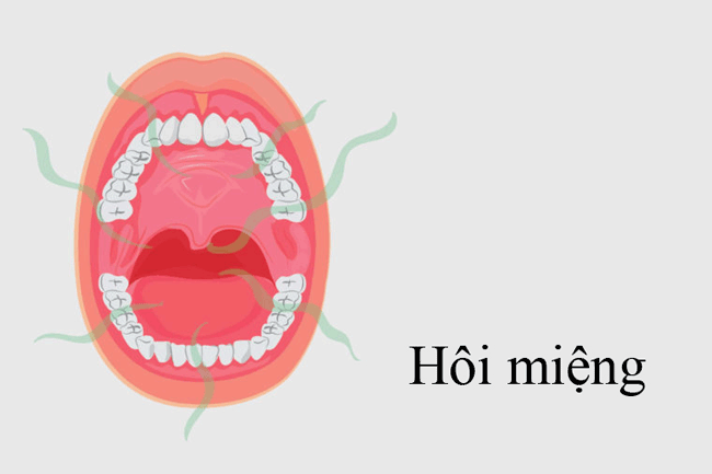 2. H&ocirc;i miệng: Mark Persky, một chuy&ecirc;n gia tại Trung t&acirc;m Ung thư Perlmutter, New York cho biết, khi một khối u ung thư miệng h&igrave;nh th&agrave;nh vết lo&eacute;t, vi khuẩn c&oacute; thể l&acirc;y nhiễm v&agrave;o vết lo&eacute;t. Những vi khuẩn đ&oacute; để lại m&ugrave;i h&ocirc;i, kh&ocirc;ng giống như hơi thở buổi s&aacute;ng th&ocirc;ng thường v&agrave; sẽ kh&ocirc;ng biến mất khi bạn đ&aacute;nh răng. C&aacute;c vi khuẩn t&iacute;ch tụ tại khối u sẽ khiến hơi thở &ldquo;bốc m&ugrave;i&rdquo; suốt cả ng&agrave;y. Nếu thấy cơ thể m&igrave;nh c&oacute; m&ugrave;i qu&aacute; 2 tuần rưỡi, h&atilde;y đến c&aacute;c cơ sở y tế để được kh&aacute;m v&agrave; tư vấn.
