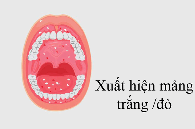 3. Xuất hiện c&aacute;c mảng m&agrave;u đỏ hoặc trắng: C&aacute;c mảng n&agrave;y mọc tr&ecirc;n nướu, lưỡi hoặc c&aacute;c khu vực kh&aacute;c trong miệng c&oacute; thể l&agrave; t&iacute;n hiệu cho thấy một khối u đang ph&aacute;t triển. Tốt nhất n&ecirc;n đến c&aacute;c cơ sở y tế để kiểm tra nếu n&oacute; k&eacute;o d&agrave;i hơn 2 tuần, đặc biệt nếu bạn nhận thấy xuất hiện th&ecirc;m c&aacute;c vết lo&eacute;t ở khu vực xung quanh.
