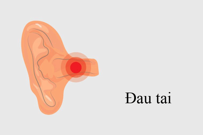 4. Đau tai chỉ ở 1 b&ecirc;n đầu c&oacute; thể kh&ocirc;ng li&ecirc;n quan g&igrave; đến tai. C&aacute;c d&acirc;y thần kinh tạo cảm gi&aacute;c cho lưỡi, ph&iacute;a sau miệng v&agrave; hộp giọng n&oacute;i cũng được li&ecirc;n kết với tai của bạn. Nếu bạn đang bị đau dai dẳng ở 1 b&ecirc;n tai v&agrave; li&ecirc;n tục t&aacute;i lại, h&atilde;y đến bệnh viện kh&aacute;m ngay lập tức. Trong trường hợp may mắn kh&ocirc;ng bị ung thư miệng, cũng cần t&igrave;m ra nguy&ecirc;n nh&acirc;n v&agrave; điều trị dứt điểm.
