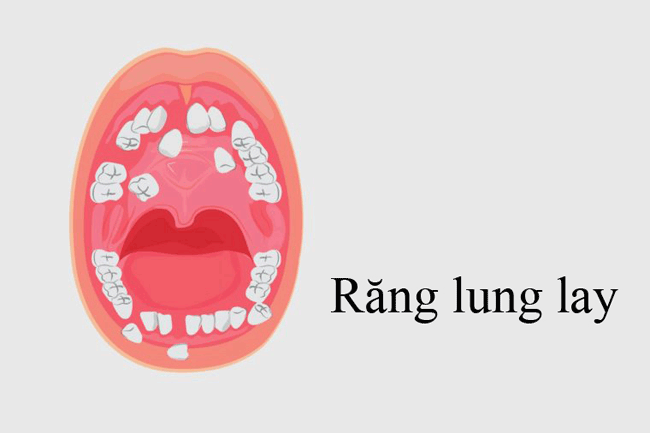8. Răng lung lay: Một khối u tr&ecirc;n nướu c&oacute; thể khiến 1 hoặc 2 c&aacute;i răng gần đ&oacute; bị lung lay. May mắn rằng, hầu hết c&aacute;c vấn đề về răng đều li&ecirc;n quan đến t&igrave;nh trạng răng của bạn chứ kh&ocirc;ng phải ung thư.
