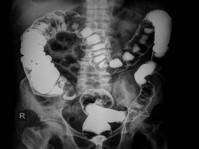 10. S&agrave;ng lọc nguy cơ ung thư: S&agrave;ng lọc ung thư trực tr&agrave;ng c&oacute; thể ph&aacute;t hiện sớm được polyp, tiền th&acirc;n của khối u sớm, thậm ch&iacute; nhiều năm trước khi ch&uacute;ng ph&aacute;t triển th&agrave;nh ung thư. C&aacute;c b&aacute;c sĩ sau đ&oacute; c&oacute; thể loại bỏ ung thư trực tr&agrave;ng bằng c&aacute;ch loại bỏ c&aacute;c polyp.
