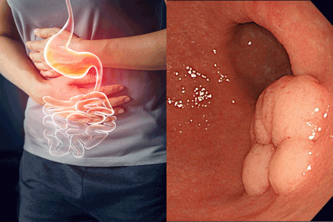 4. Mất cảm gi&aacute;c ngon miệng: Sẽ kh&ocirc;ng c&oacute; vấn đề g&igrave; nghi&ecirc;m trọng nếu bạn bị mất cảm gi&aacute;c ngon miệng trong 1 hoặc 2 ng&agrave;y, nhưng nếu t&igrave;nh trạng k&eacute;o d&agrave;i hơn h&atilde;y đến gặp b&aacute;c sĩ để được kh&aacute;m v&agrave; chẩn đo&aacute;n. Ung thư dạ d&agrave;y l&agrave; một trong nhiều t&igrave;nh trạng c&oacute; thể g&acirc;y mất cảm gi&aacute;c ngon miệng k&eacute;o d&agrave;i.