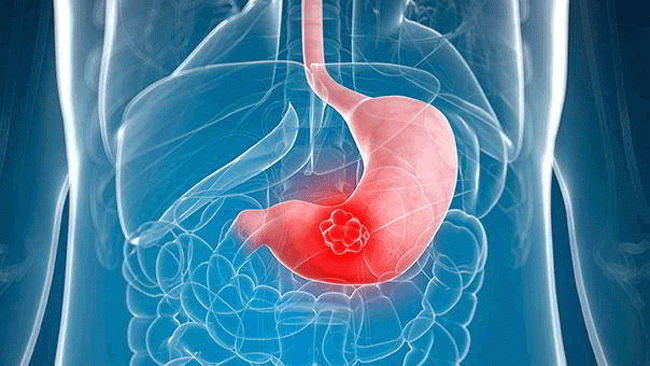 5. Bụng đầy hơi c&oacute; thể l&agrave; triệu chứng của ung thư dạ d&agrave;y, đặc biệt l&agrave; khi n&oacute; xảy ra sau bữa ăn. Nếu bạn thường xuy&ecirc;n cảm thấy chướng bụng v&agrave; kh&ocirc;ng c&oacute; lời giải th&iacute;ch, h&atilde;y đến gặp b&aacute;c sĩ để được x&aacute;c định r&otilde; nguy&ecirc;n nh&acirc;n. Ngo&agrave;i ung thư dạ d&agrave;y, đầy hơi chướng bụng thường l&agrave; triệu chứng đầu ti&ecirc;n của ung thư buồng trứng.