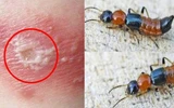 Bác sĩ cảnh báo không chủ quan với tổn thương do kiến ba khoang gây ra