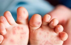 Hà Nội tăng trẻ mắc bệnh tay chân miệng, lưu ý dấu hiệu biến chứng