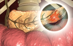 Người đàn ông 42 tuổi phát hiện mắc ung thư chỉ vài tuần sau khi có dấu hiệu này