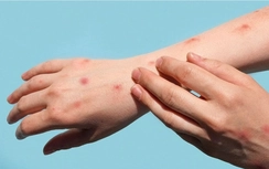 TP.HCM: Kết quả giải mã gene ca mắc đậu mùa khỉ nội địa đầu tiên