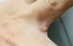 TP.HCM ghi nhận thêm ca đậu mùa khỉ thứ 5 ở quận Tân Bình