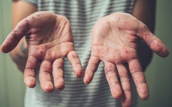 Thêm 4 ca mắc đậu mùa khỉ, có lo ngại bùng dịch?