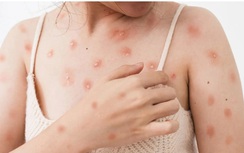 Bệnh nhân nhiễm đậu mùa khỉ đầu tiên ở Cần Thơ giờ ra sao?