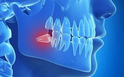 Răng số 8 mọc lệch không đau, có nên nhổ?