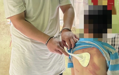 Khởi tố người đàn ông hành hạ dã man con ruột 5 tuổi